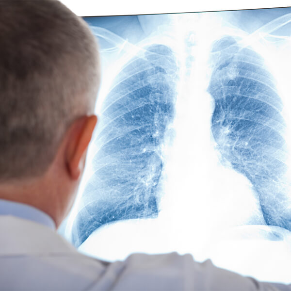 radon induced lung cancer